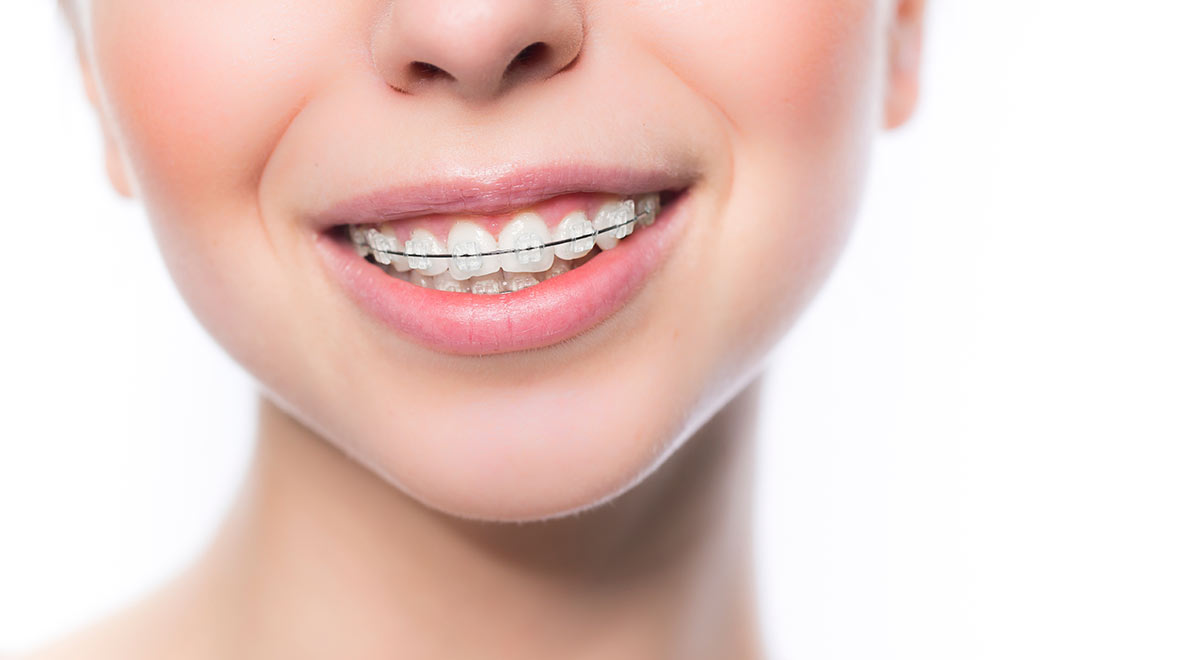 брекет система damon clear