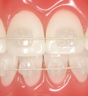 Что такое дистальный прикус и как его лечить?