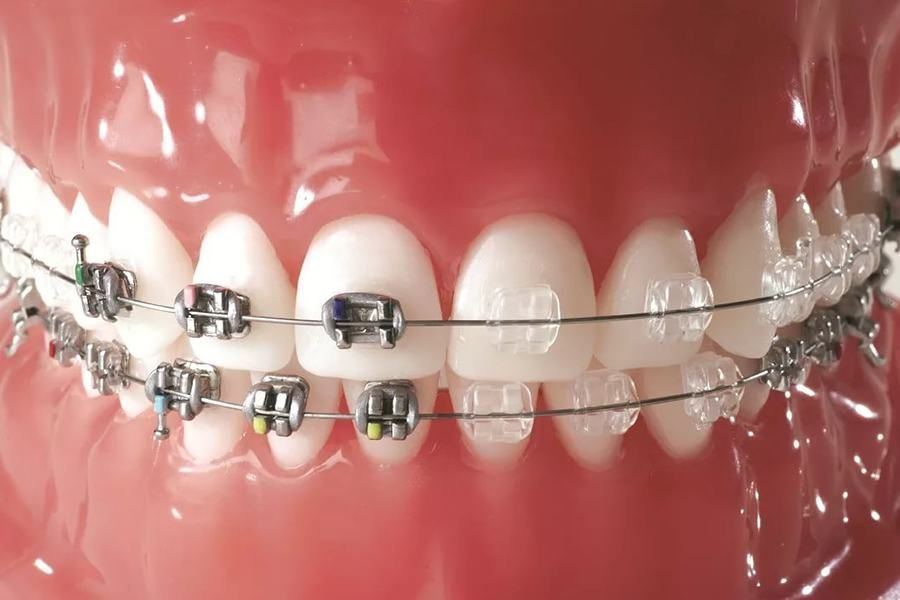 дистальный прикус брекеты