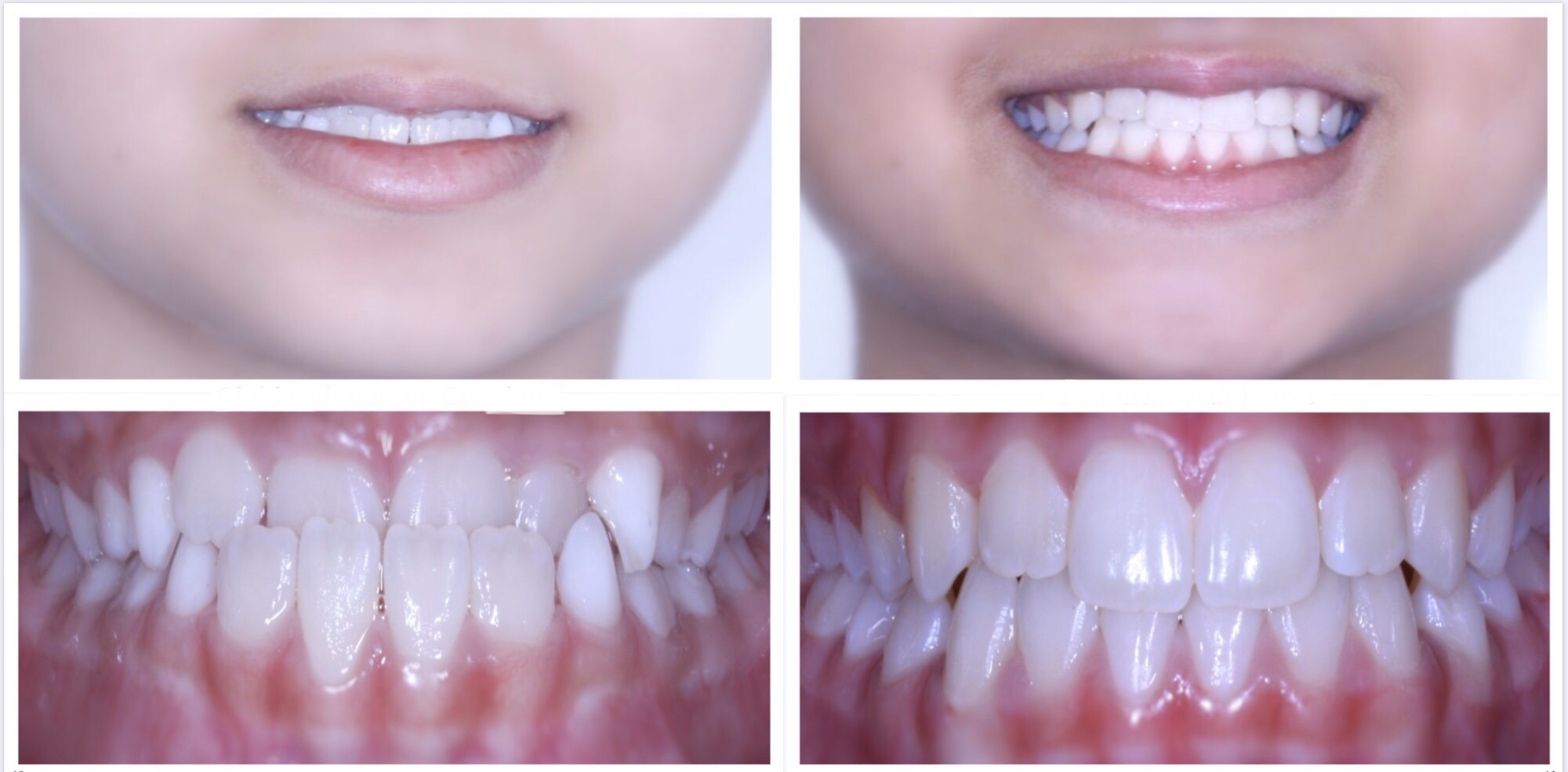 дистальный прикус брекеты