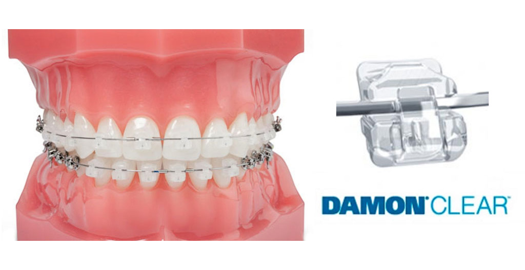 брекеты https://ormco.ru/market/brekety/damon-system/esteticheskie/brekety-damon-clear-2/