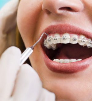 Брекеты Damon Сlear2: конструктивные особенности