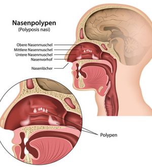 Сведения об удалении носовых полипов