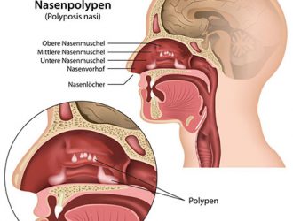 Сведения об удалении носовых полипов