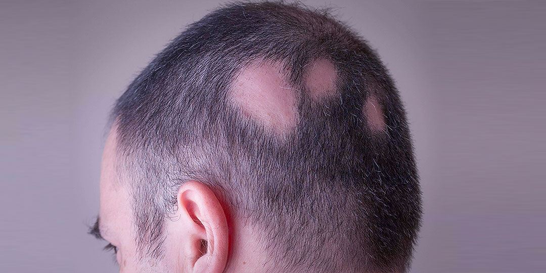 Что такое трихотилломания и ее симптомы