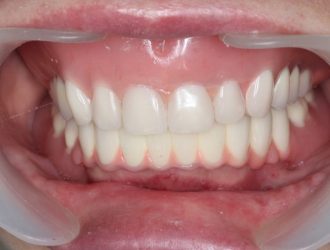 Современные методы лечения зубов и десен: обзор и рекомендации