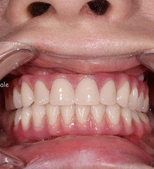 Протезирование зубов: разумная цена за красивую и здоровую улыбку