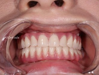 Протезирование зубов: разумная цена за красивую и здоровую улыбку