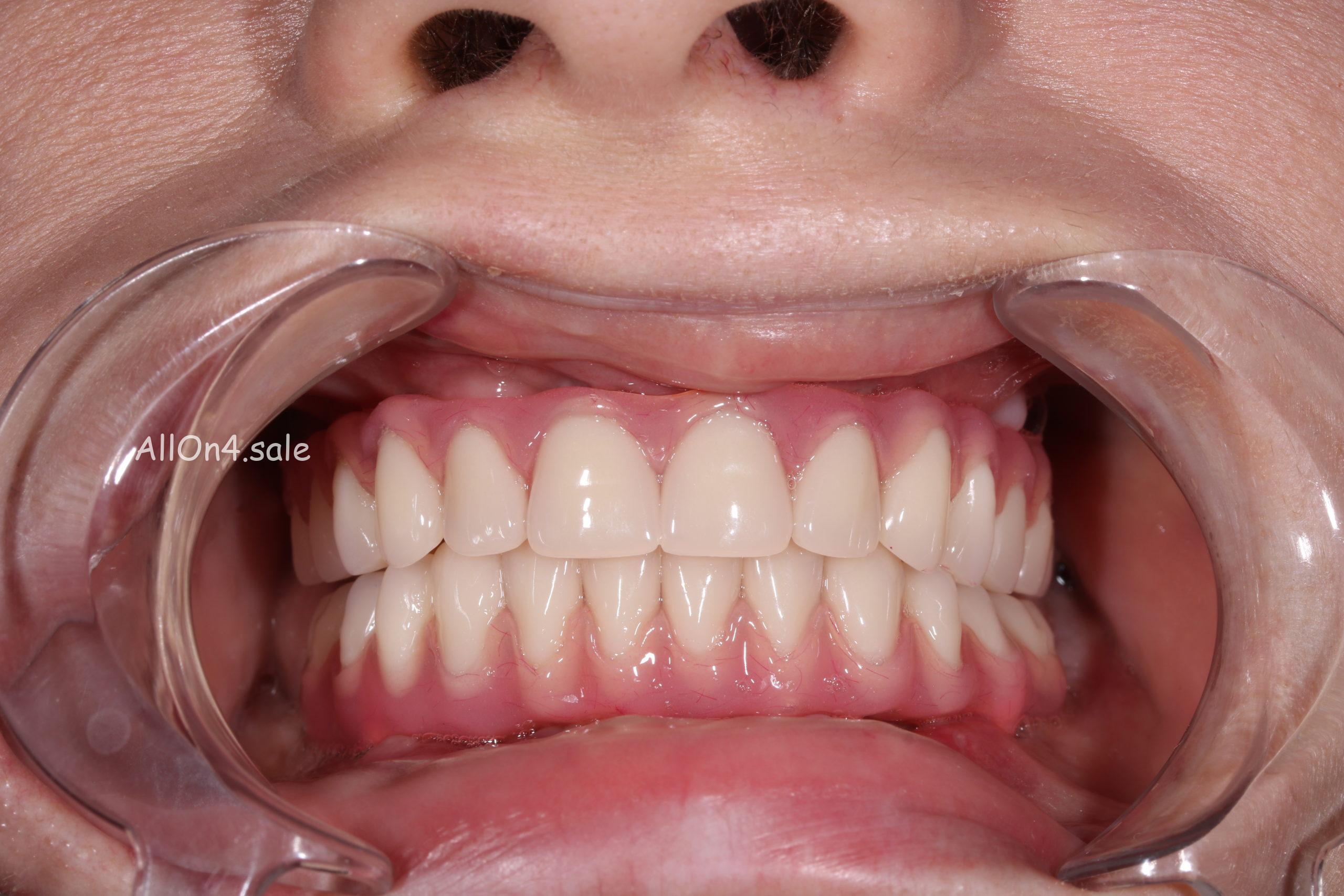 Протезирование зубов: разумная цена за красивую и здоровую улыбк