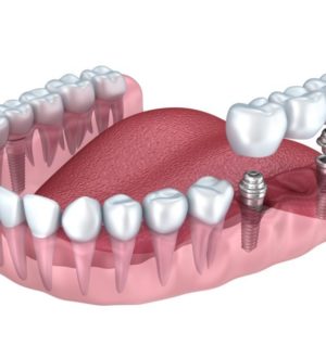 Протезирование зубов
