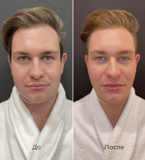 Что такое СМАС лифтинг?