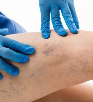 Варикоз (варикозное расширение вен) – симптомы, причины, признаки, диагностика и лечение в Медицинском центре «Диамед»