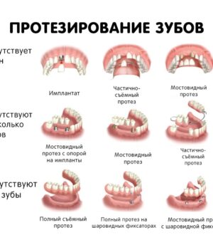 Протезирование зубов