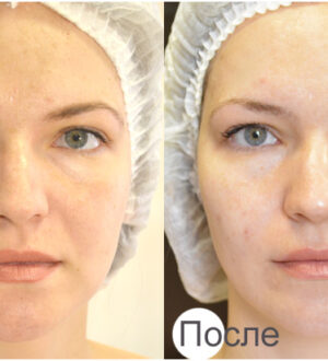 Что такое карбокситерапия?