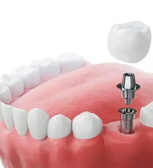 Зубные импланты: все, что нужно знать