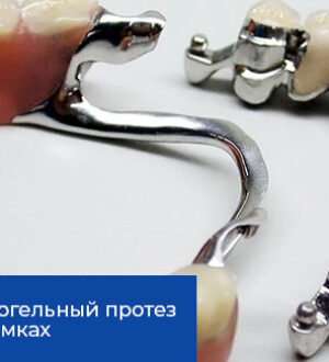 Чем является бюгельный протез на нижнюю челюсть
