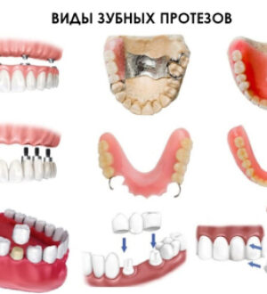 Виды протезов