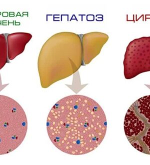 Что такое неалкогольная жировая болезнь печени?