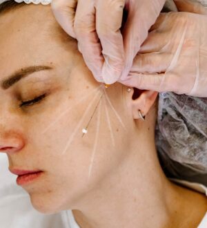 Что такое мезонити для подтяжки лица